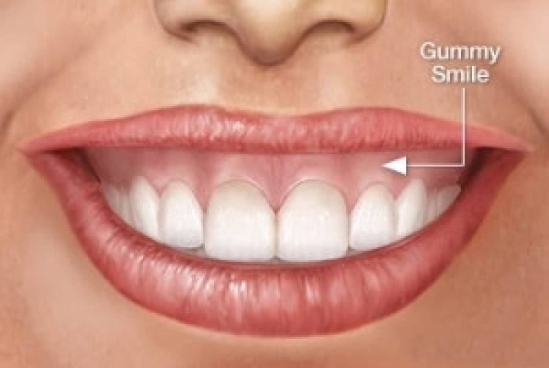 Aplicação de Botox Terapêutico Odontológico Alto da Lapa - Dentista Que Usa Botox