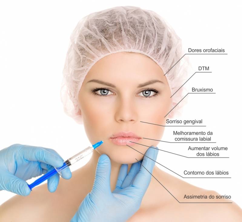 Botox Odontológicos para Estéticas em Perdizes - Botox Terapêutico Odontológico