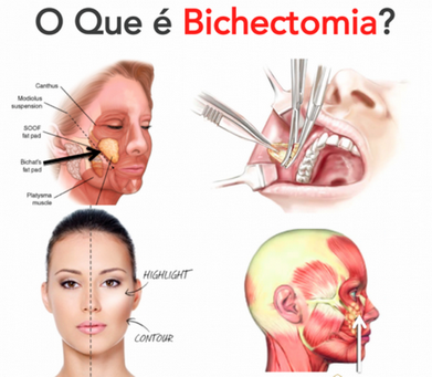 Cirurgia de Bichectomia em Homens Pacaembu - Bichectomia para Reduzir Bochechas