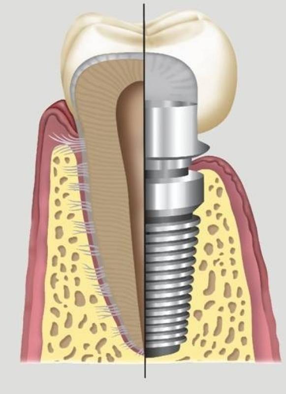 Cirurgia de Implantes Dentários Consolação - Implante Dentário de um Dente
