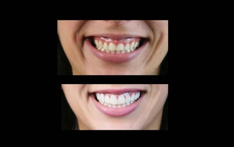 Cirurgia para Gengiva Preço em São Domingos - Clínica de Estética Dentária