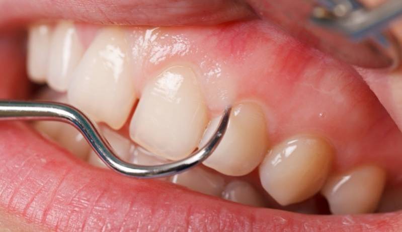Cirurgia para Gengiva Parque Residencial da Lapa - Clínica de Estética para Dentes