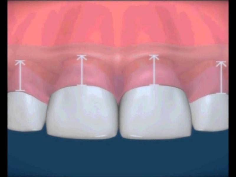 Cirurgias para Gengiva Jardim Everest - Clínica de Estética Odontológica
