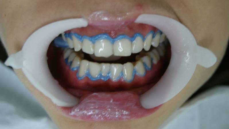 Clareamentos Dentais de Dentista na Bela Vista - Clareamento Dental
