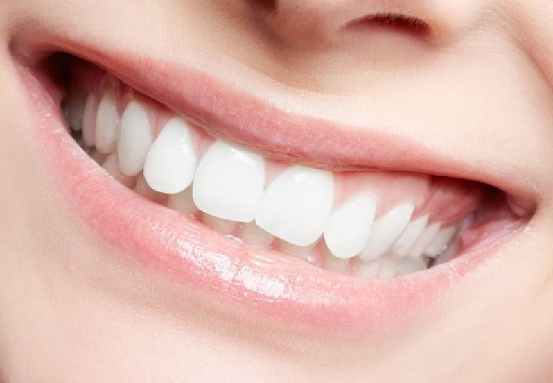 Clareamentos e Branqueamento Dental na Lapa - Clareamento para Dentes com Resina