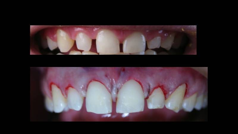 Clínica de Cirurgia para Gengiva na Lapa - Clínica de Estética Odontológica
