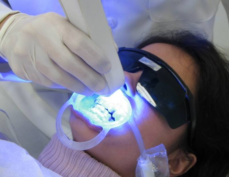 Clínica de Clareamento Dental de Consultório na Vila Anglo Brasileira - Clareamento Dental Adesivo