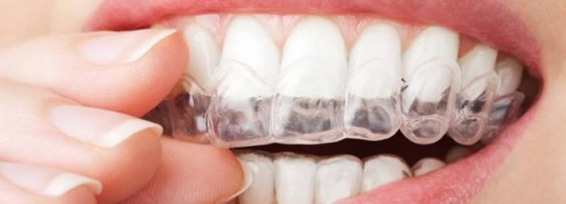 Clínica de Clareamento Dentário de Consultório na Vila Anastácio - Clareamento Dental de Consultório