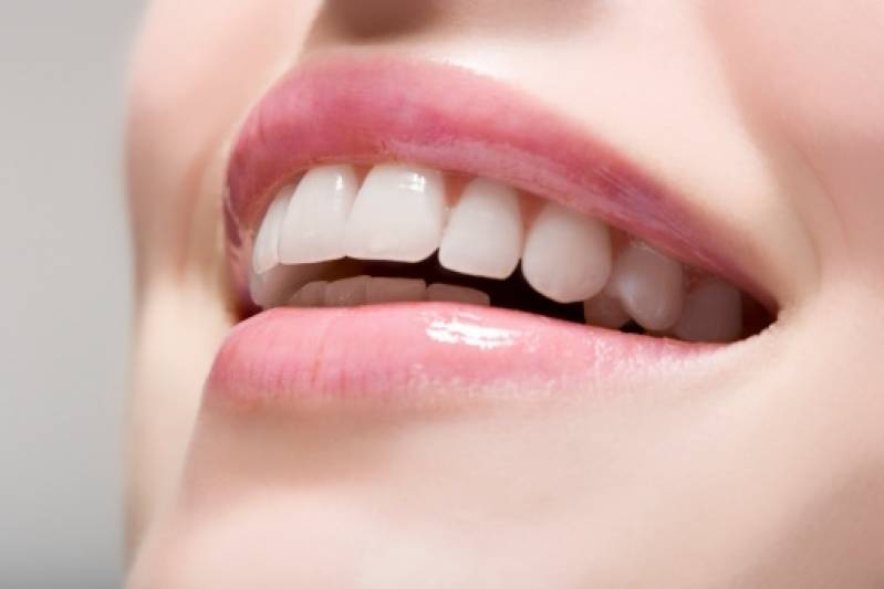 Clínica de Clareamento e Branqueamento Dental na Lapa - Clareamento Dental de Dentista