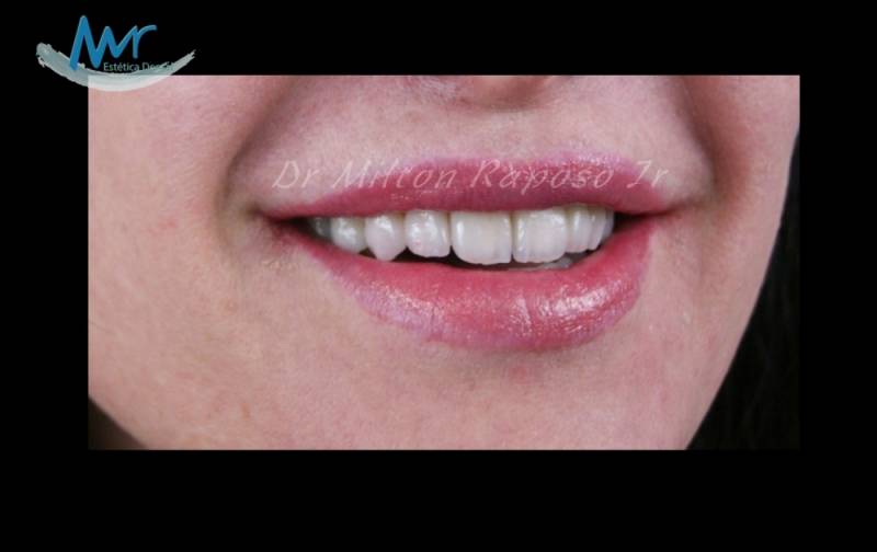 Clínica de Estética Dental de Gengiva na Água Branca - Estética Dental para Implantes