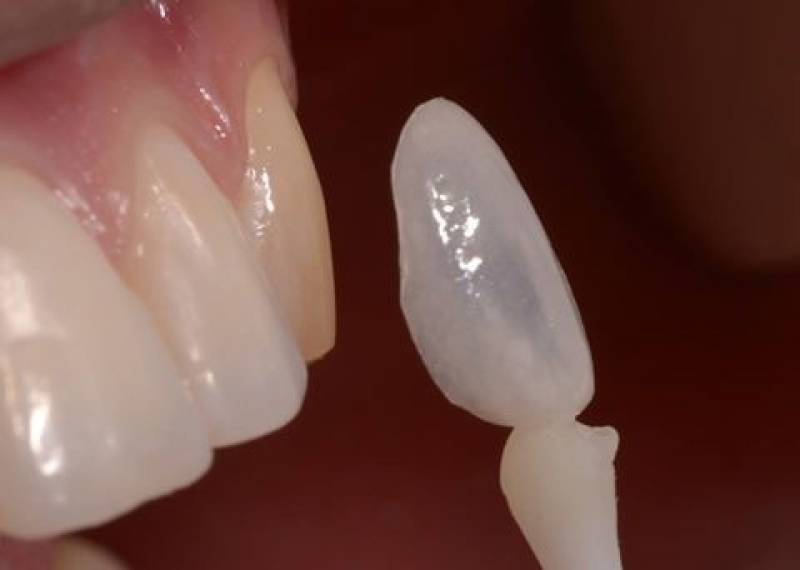 Clínica de Estética Dental para Implantes Bairro do Limão - Estética Dental com Dentes Separados