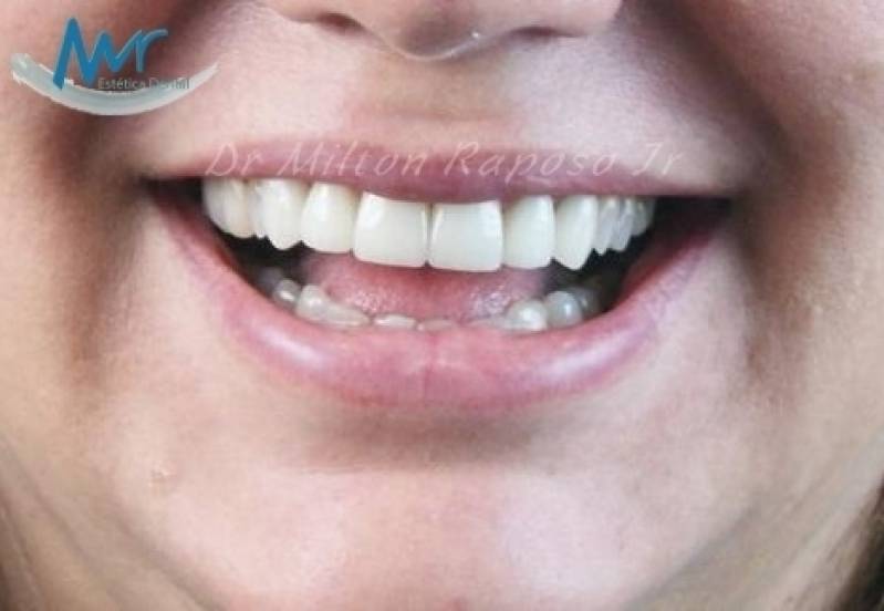 Clínica de Estética Dental para Lente Dental Preço na Água Branca - Clínica para Estética Dentária