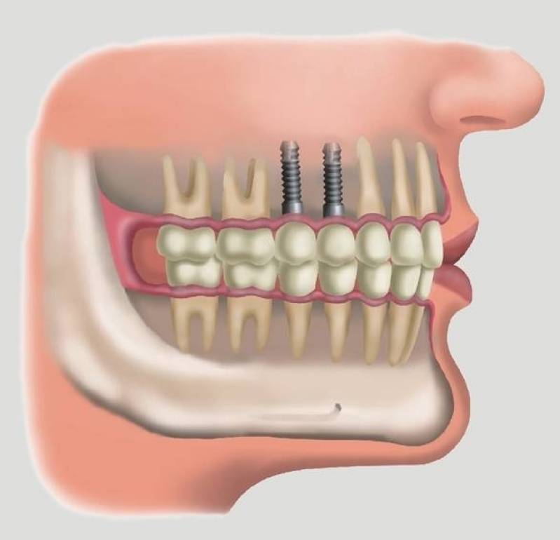 Clínica de Implante de Dentes Superiores Parque Residencial da Lapa - Implante Dentário de Carga Imediata