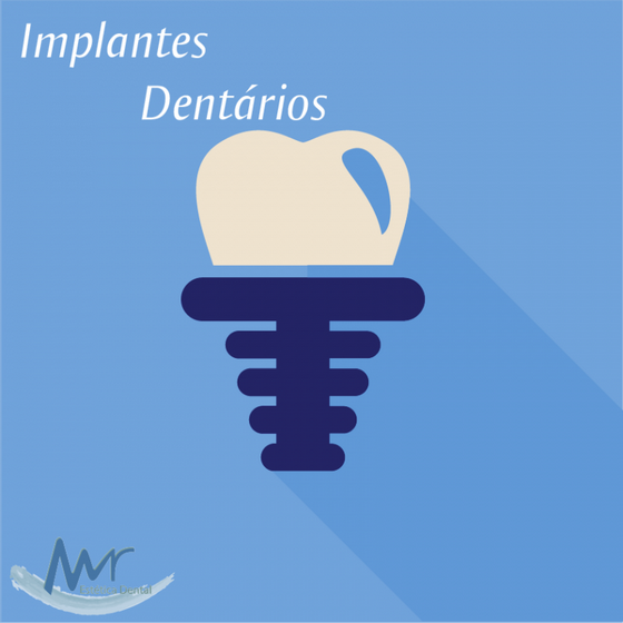 Clínica de Implante Dentário de Carga Imediata em Pinheiros - Implante de Dentes