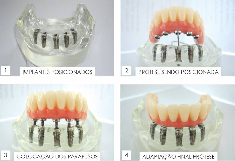 Clínica de Implante Dentário Dente da Frente em Higienópolis - Implante Dentário após Extração