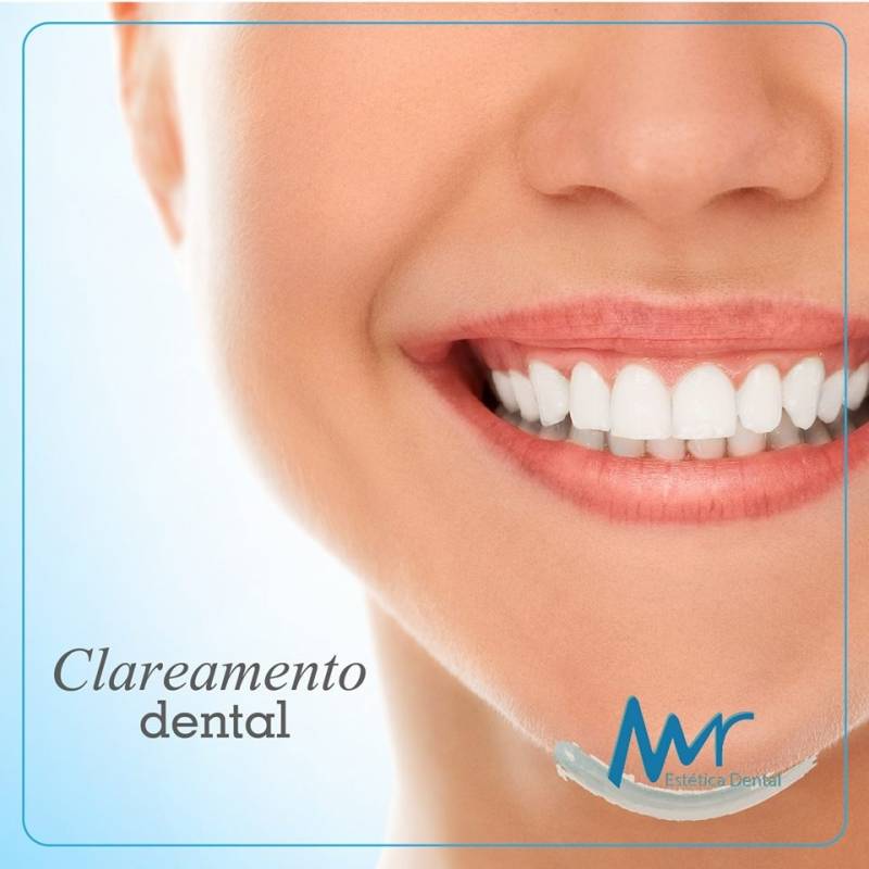 Clínica de Limpeza e Clareamento Dental na Freguesia do Ó - Clareamento Dental Adesivo
