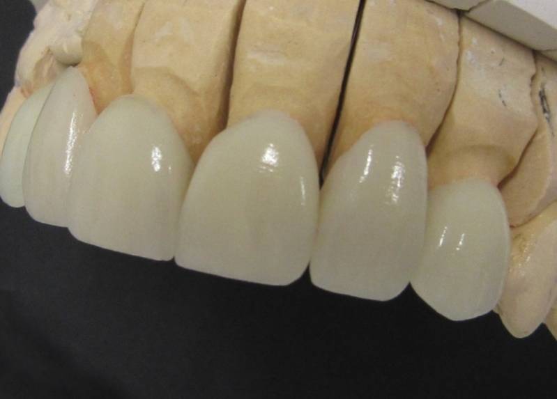 Clínica de Restauração Dental em Sp na Freguesia do Ó - Restauração Dentária com Porcelana