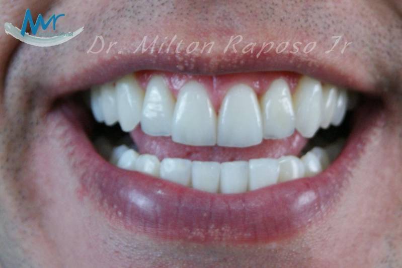 Clínicas de Estética para Clareamento Dental a Laser Parque Residencial da Lapa - Clínica Odontológica de Estética