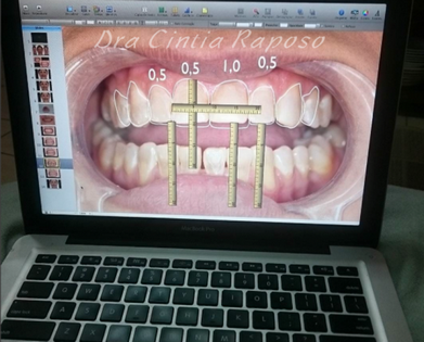 Estéticas Dentais de Gengiva em Pinheiros - Estética Dental com Dentes Separados