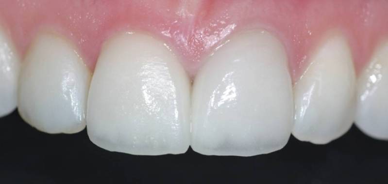 Faceta de Dente na Pompéia - Faceta Lisa Dental