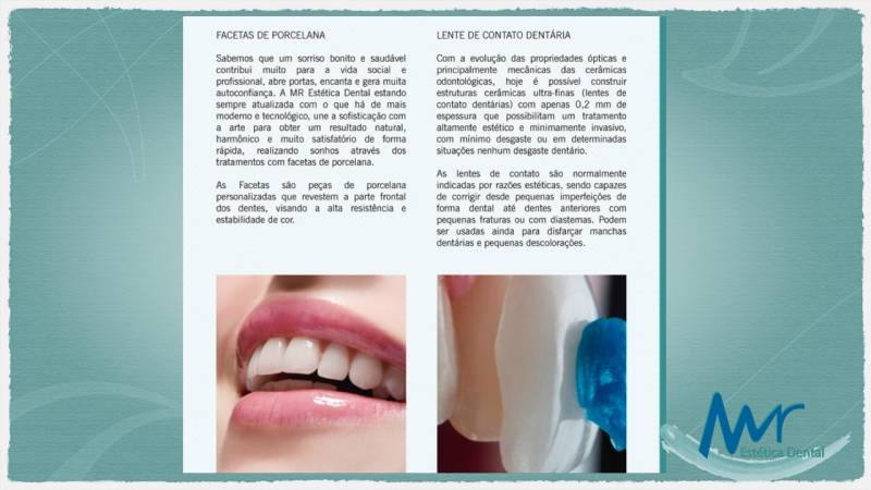 Faceta Dental Preço em São Domingos - Faceta Dental de Resina