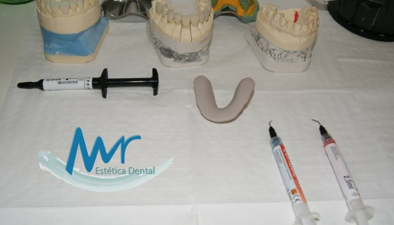 Faceta Tratamento Dentário Preço em Higienópolis - Faceta Lisa Dental