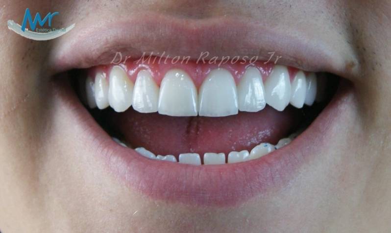 Faceta Tratamento Dentário na Vila Romana - Faceta Dental Indireta