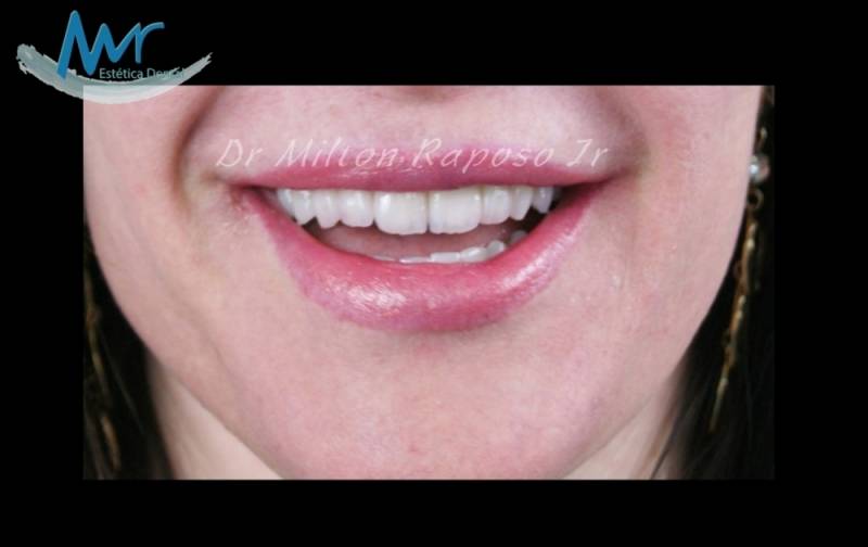 Facetas Dentárias para Dentes Tortos na Pompéia - Faceta Clareamento Dental