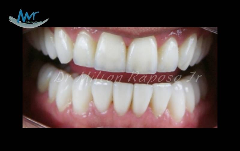 Facetas Lisas Dentais em Higienópolis - Faceta Tratamento Dentário