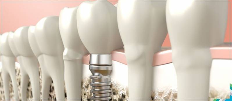 Implante de Dentes Superiores Preço na Cerqueira César - Implante Dentário após Extração