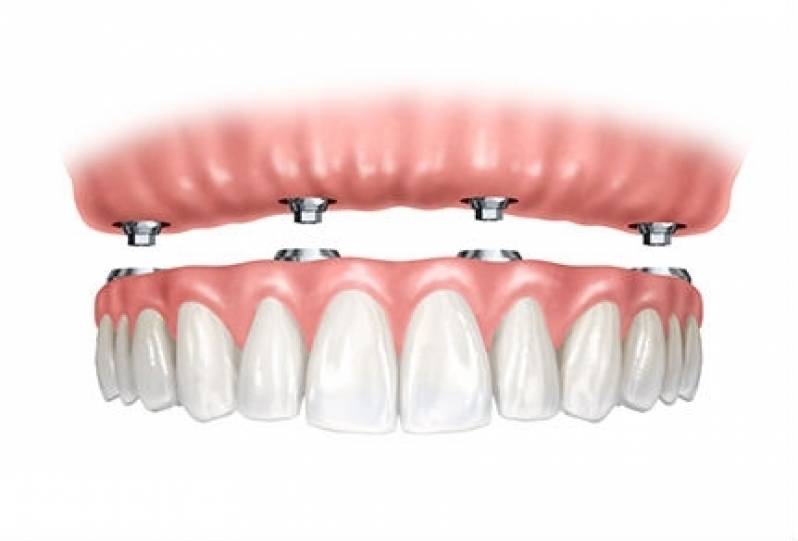 Implante Dentário após Extração Preço Alto da Lapa - Implante Dentário de um Dente