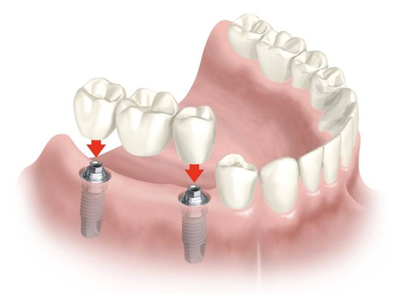 Implante Dentário com Enxerto ósseo Preço na Lapa - Implante Dentário