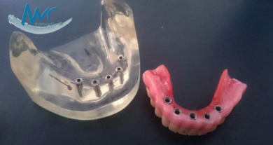 Implante Dentário de Carga Imediata Parque Residencial da Lapa - Implante Dentário de um Dente