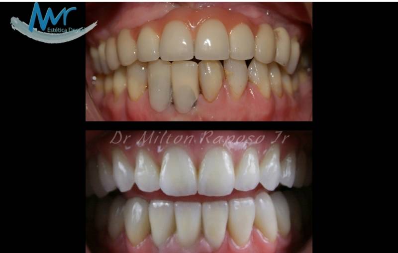 Implante Dentário de Porcelana na Vila Romana - Implante Dentário de Titânio