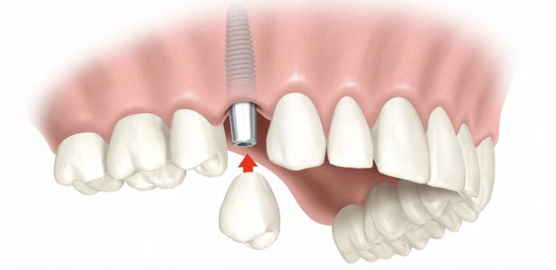 Implante Dentário de Titânio na Vila Madalena - Implante Dentário Dente da Frente