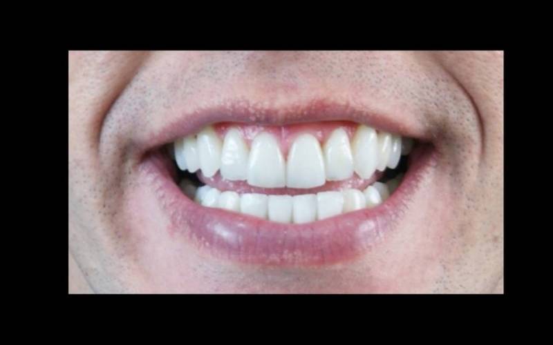 Implante Dentário de um Dente em Perdizes - Implante Dentário de um Dente