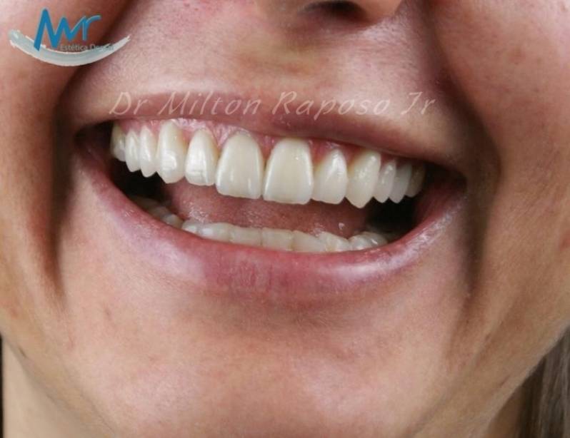 Implante Dentário Preço na Barra Funda - Implante Dentário de Porcelana