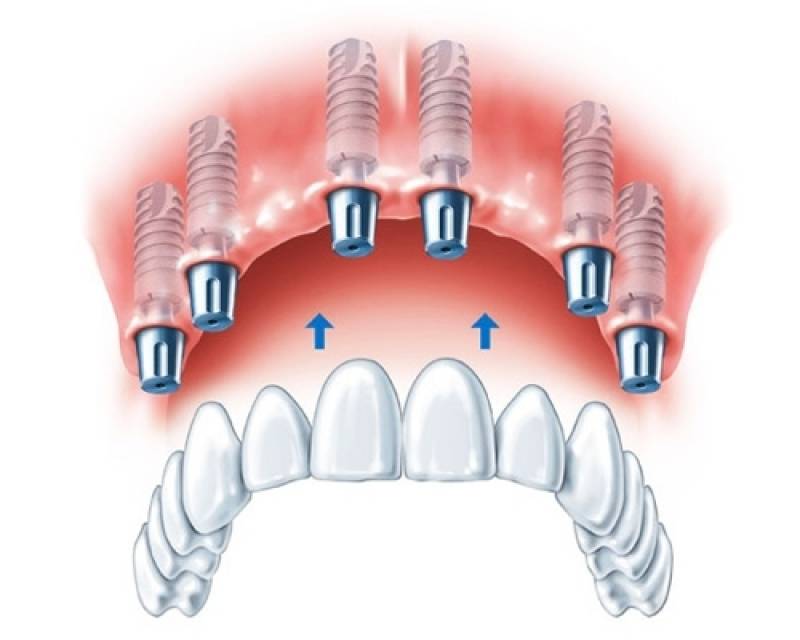 Implante Dentários Dente da Frente na Freguesia do Ó - Implante Dentário de Titânio