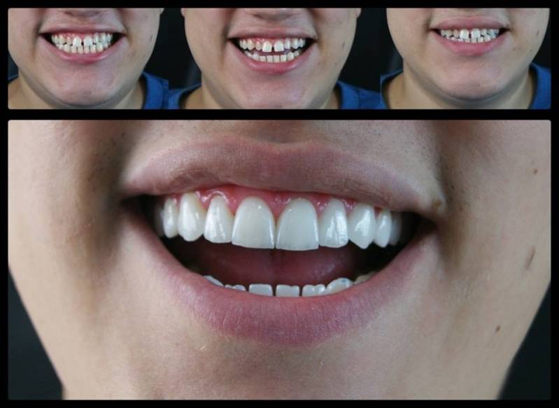 Lente de Contato Dental em Porcelana em Sumaré - Lente de Contato de Prótese Dentária