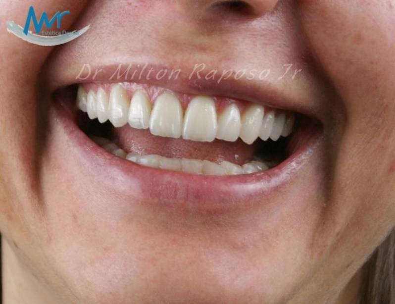 Lente de Contato Dentária na Vila Anastácio - Lente de Contato Odontológica