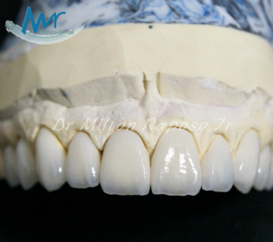 Lente Dentária de Porcelana Preço Sumarezinho - Lente de Contato de Prótese Dentária