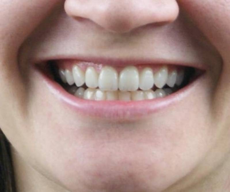 Lentes Dentais Preço Alto de Pinheiros - Lente de Dentes