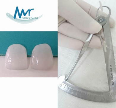 Lentes Dentárias em Sumaré - Lente de Contato Odontológica