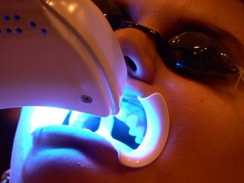 Orçamento de Clareamento para Dentes com Resina Jardim Everest - Clareamento Dental Interno