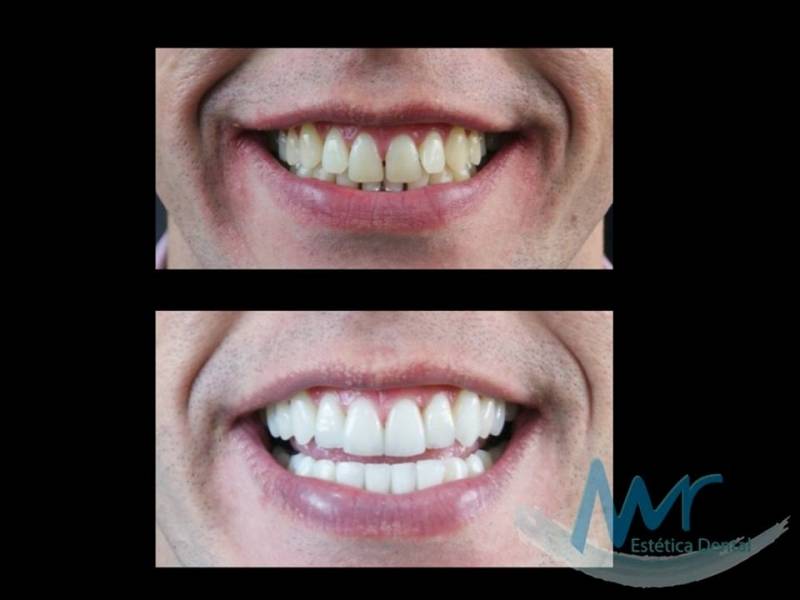 Orçamento de Lente de Contato Dental em Porcelana na Vila Anastácio - Lente de Contato Odontológica