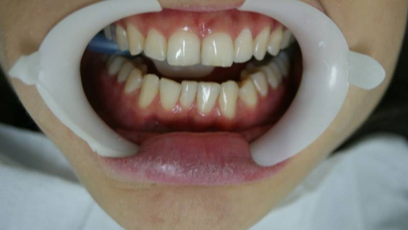 Orçamento de Limpeza e Clareamento Dental na Bela Vista - Clareamento Dental com Moldeira
