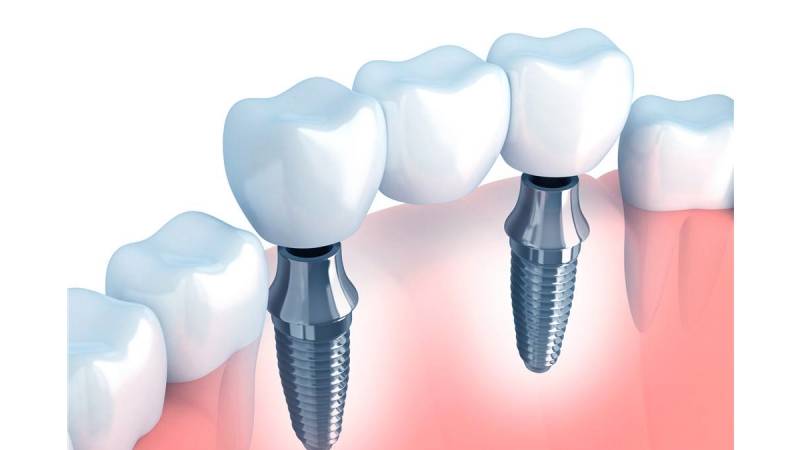 Prótese Dentária Cimentada na Vila Madalena - Prótese Cimentada Implante
