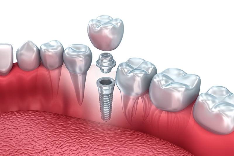 Prótese Dentária Fixa Alto da Lapa - Prótese Dentária Removível
