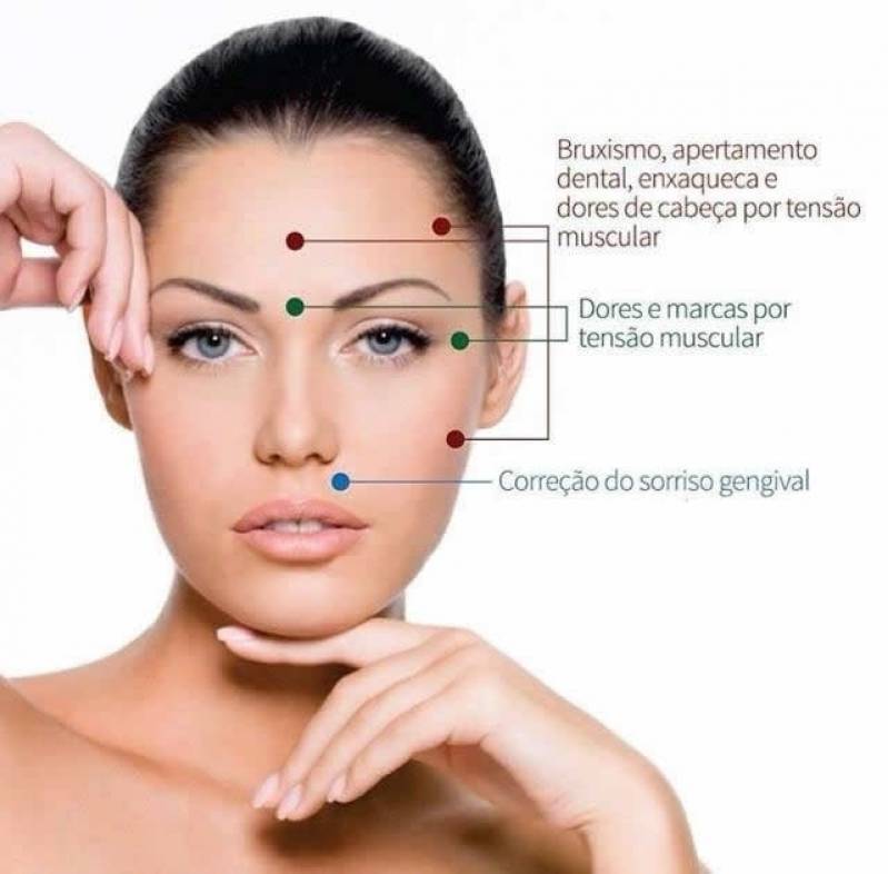Quanto Custa Aplicação de Botox para Diminuir Gengiva na Vila Madalena - Tratamento Odontológico com Botox