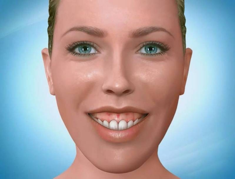 Quanto Custa Aplicação de Botox para Gengiva Grande em Higienópolis - Botox Odontológico para Estética